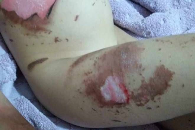 Braço queimado da criança após explosão de celular - Reprodução