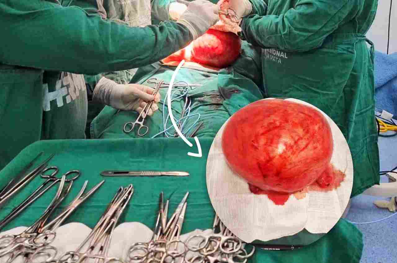 Cirurgia para retirada do 'Mioma gigante' foi concluída com sucesso
