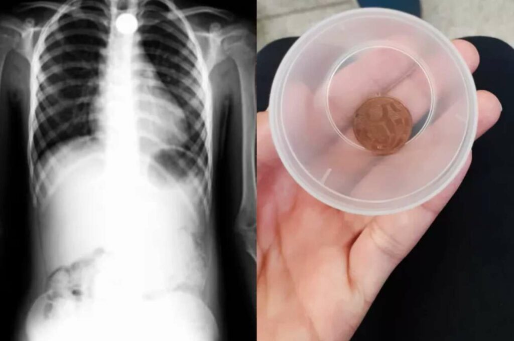 Criança de 6 anos fica sufocada ao engolir moeda e bombeiros são acionados