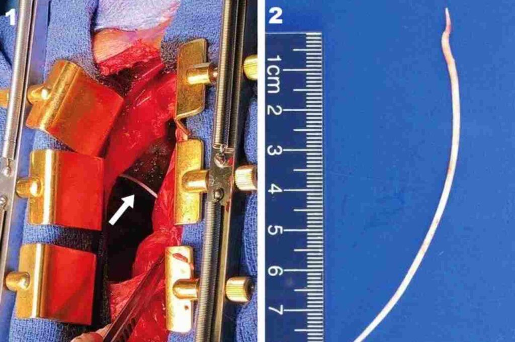 Pedaço de 10 cm de cimento foi identificado após operação para reparar fratura | © The New England Journal of Medicine
