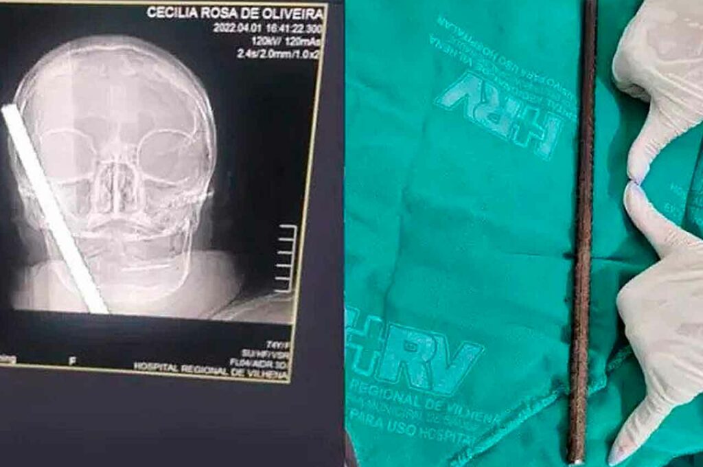 ‘Milagre’: Idosa tem cabeça perfurada por vergalhão e sobrevive