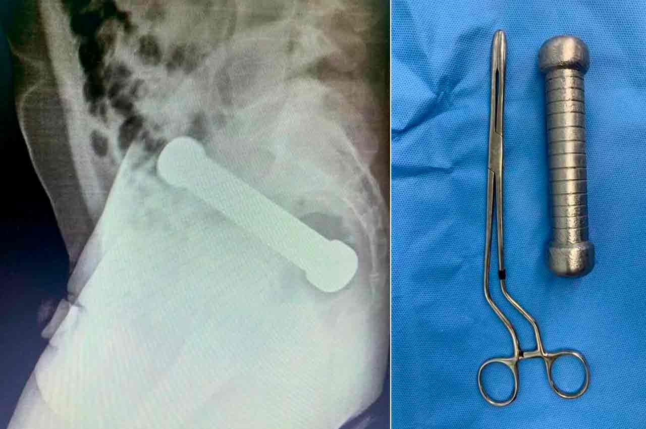 Pelas imagens do raio-x, foi possível ver um peso de 20cm entre o reto e o intestino grosso do paciente | © Reprodução/Science Direct