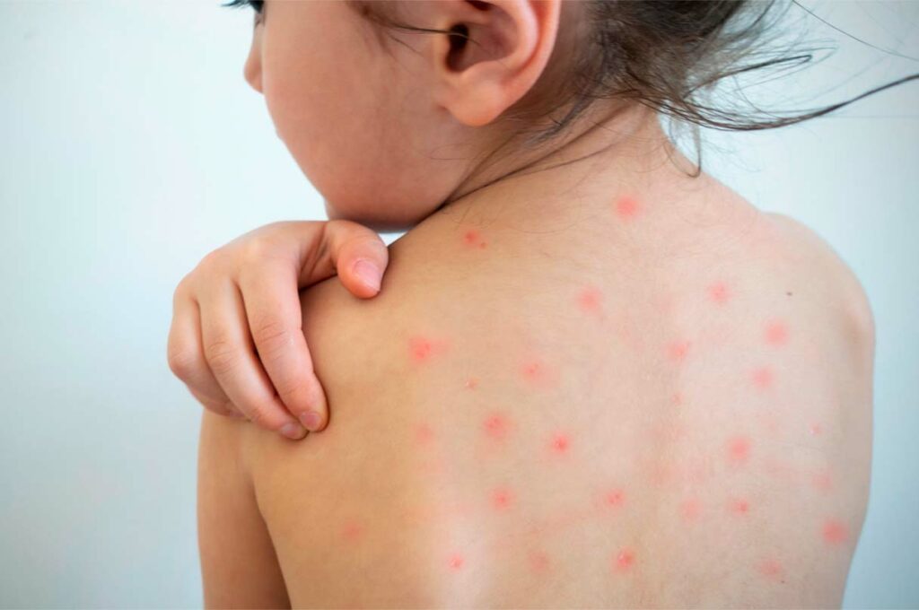 Casos suspeitos de Sarampo são registrados em alguns estados do Brasil