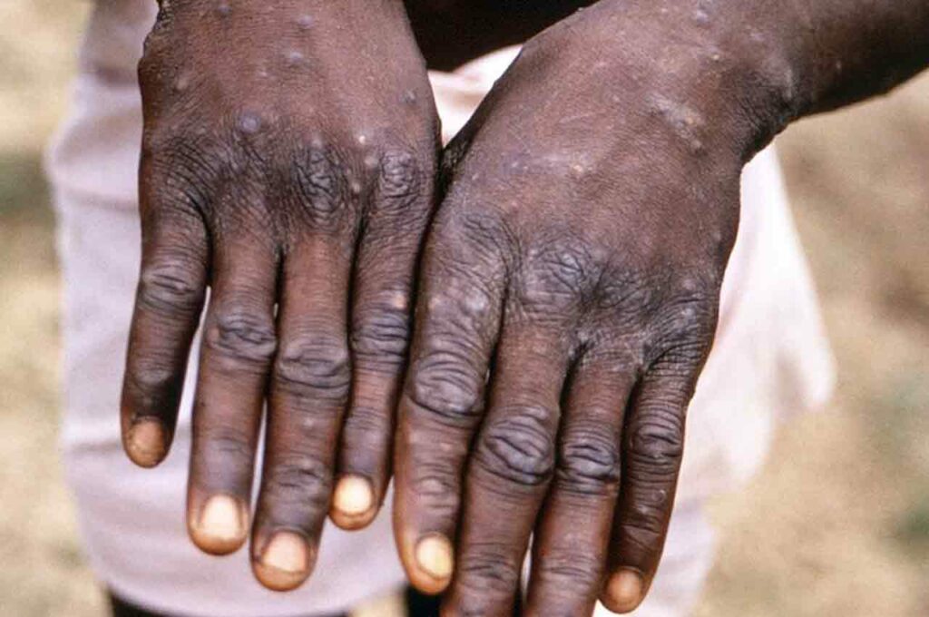 Varíola dos macacos: Sintomas, transmissão, vacinas e prevenção