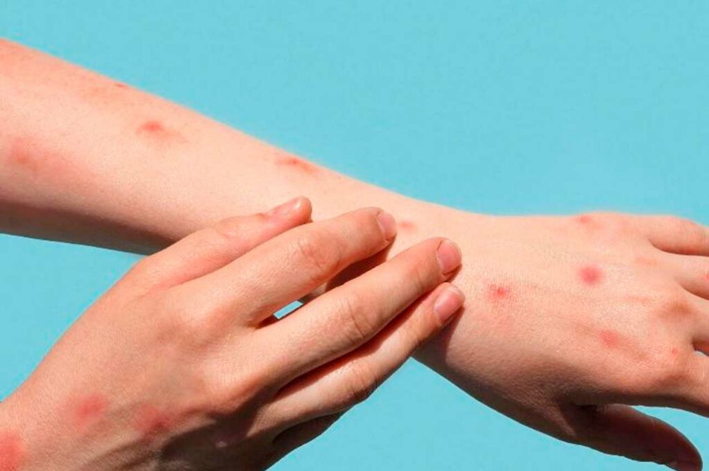 Brasil registra mais de mil casos de Varíola dos Macacos em 2024