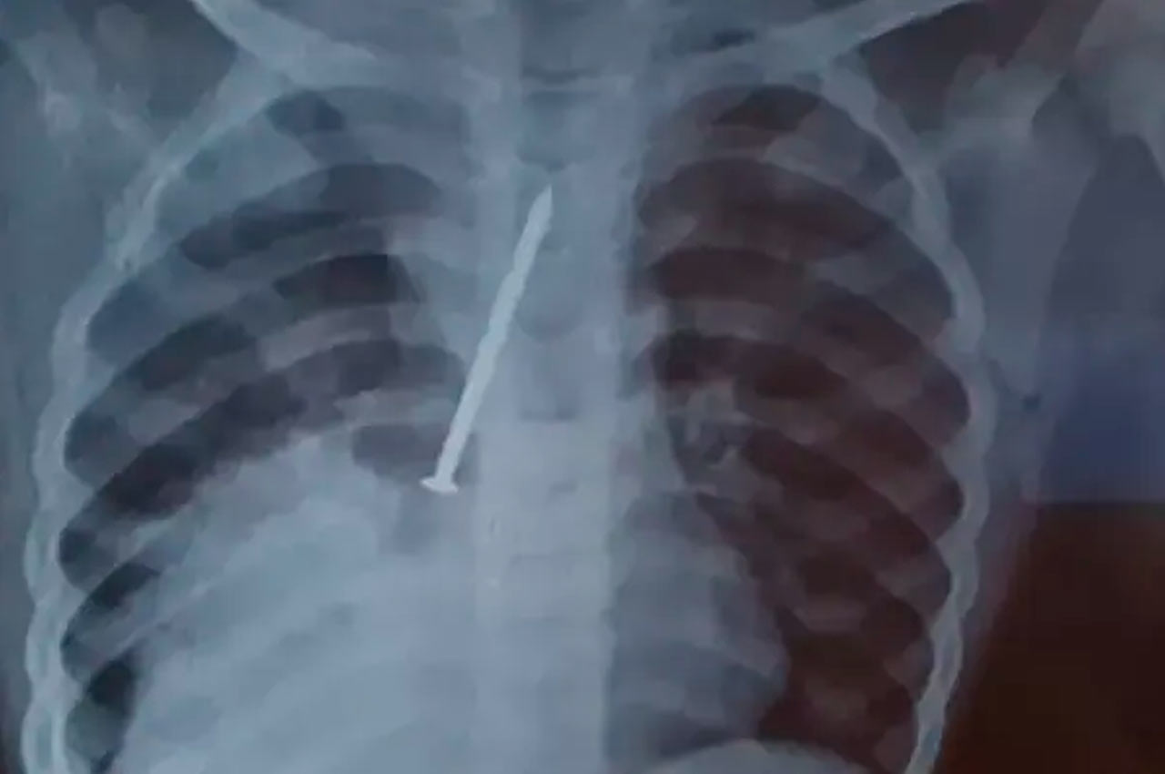 Criança de 3 anos morre após passar um ano com prego no pulmão | © Reprodução