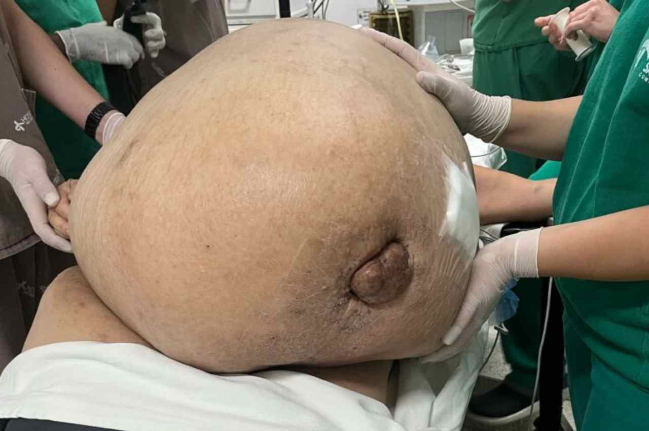 Tumor de 46 kg foi removido após duas horas de cirurgia | Foto: Arquivo pessoal do cirurgião Glaucio Boechat