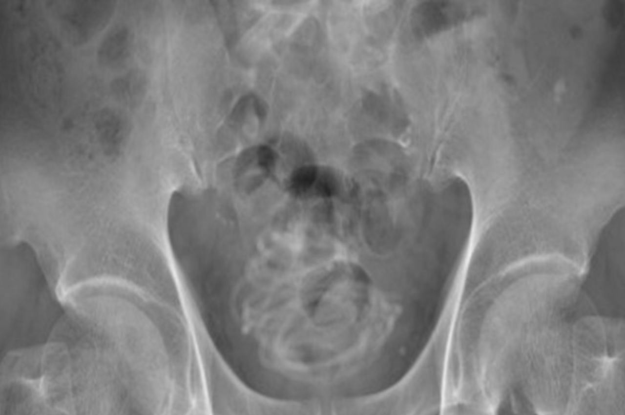 Corda de pular é encontrada dentro de bexiga de paciente | © Divulgação/Urology Case Reports