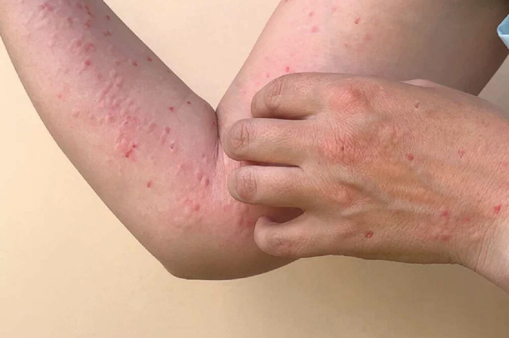 Monkeypox: Alagoas registra 26 casos da doença em diversos municípios