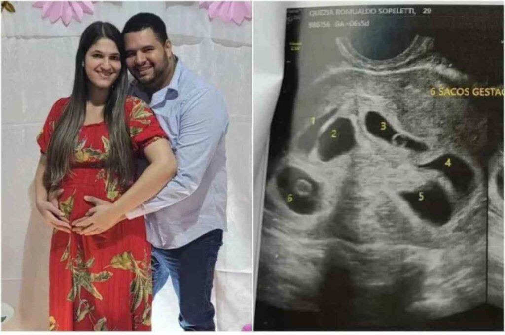 Mulher descobre gravidez de sêxtuplos em ultrassom no Espírito Santo