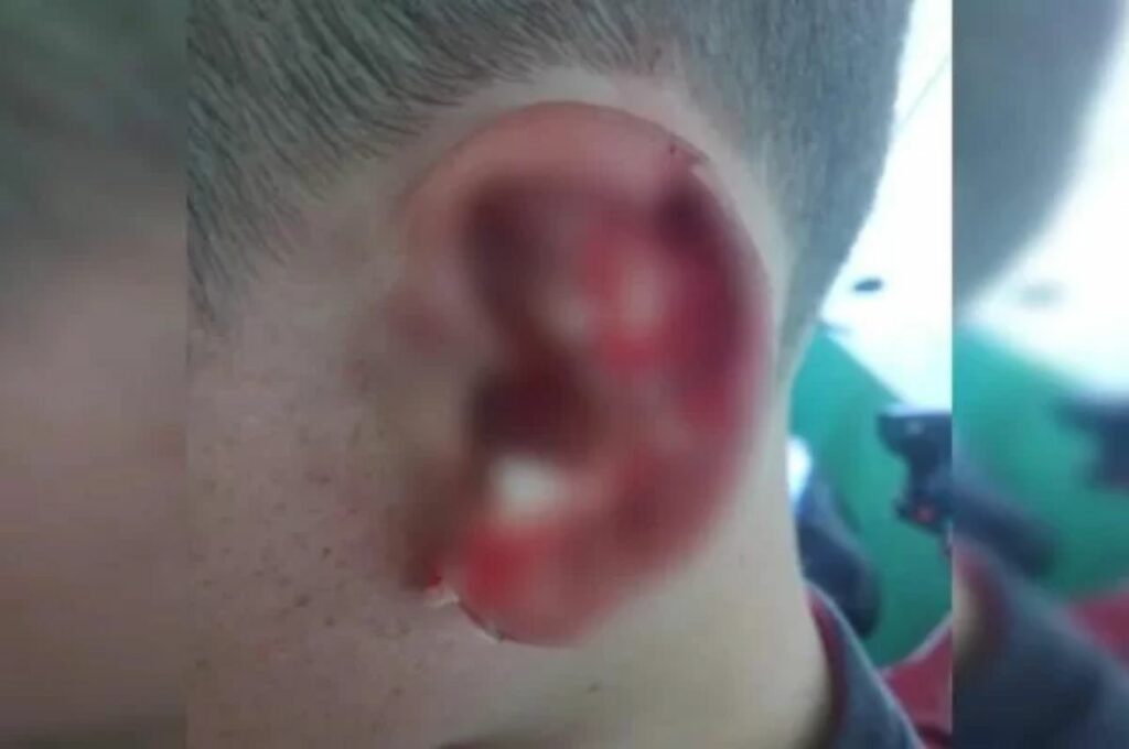 Aluno autista tem parte da orelha arrancada por adolescente em escola