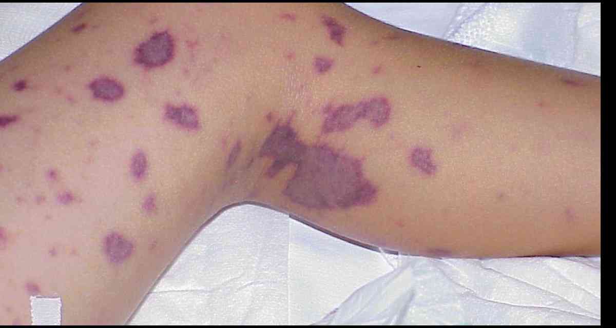 Saúde orienta a população sobre sinais e sintomas da Meningite Saúde orienta a população sobre sinais e sintomas da Meningite