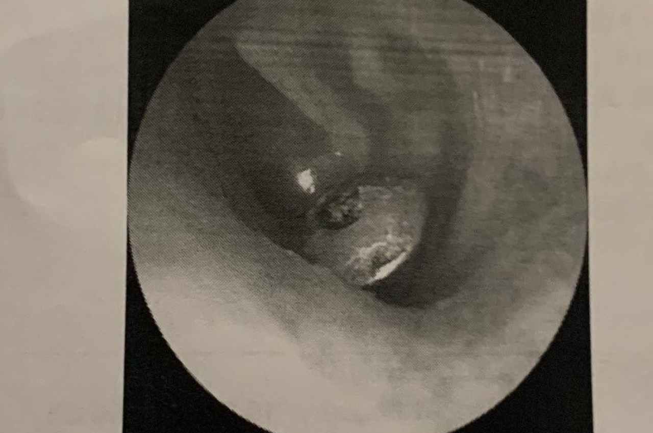 Imagem de tarraxa presa no ouvido da paciente | @ Reprodução/Instagram
