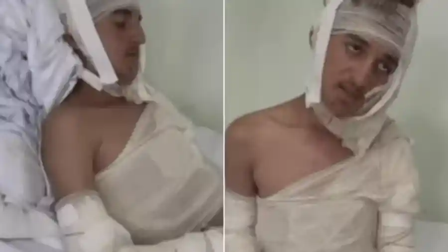 Jovem tem corpo queimado com óleo quente após briga de família