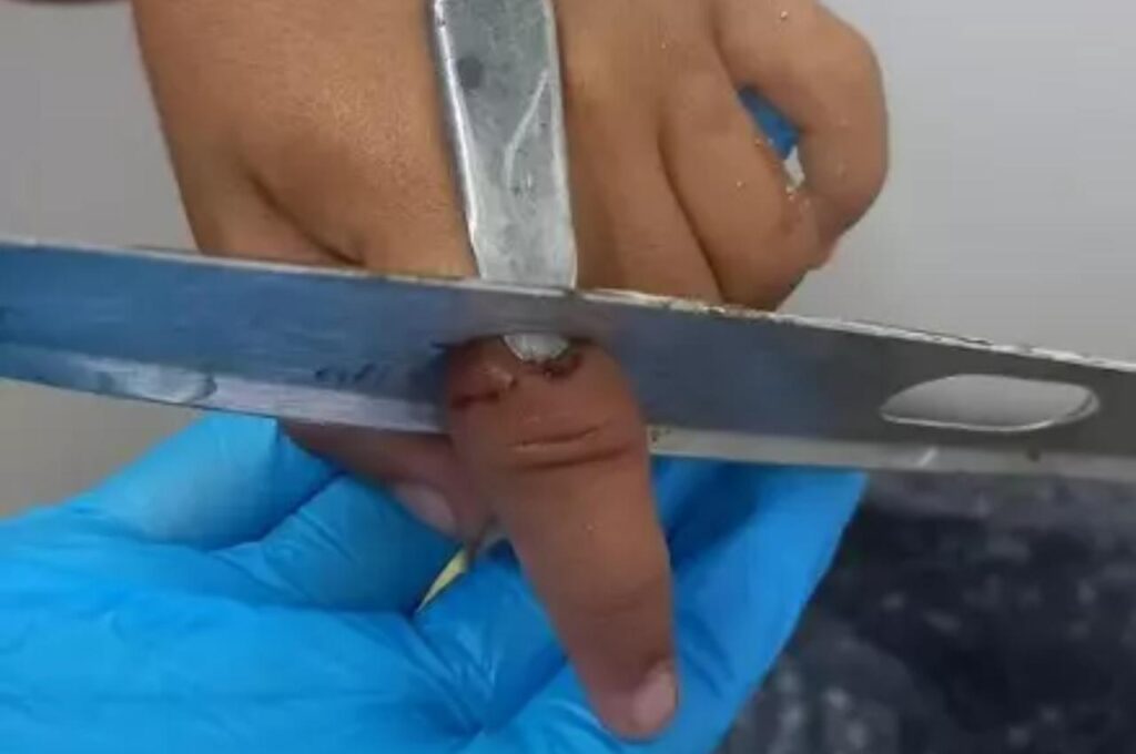 Criança é socorrida pelos bombeiros após ficar com fechadura presa no dedo em União dos Palmares