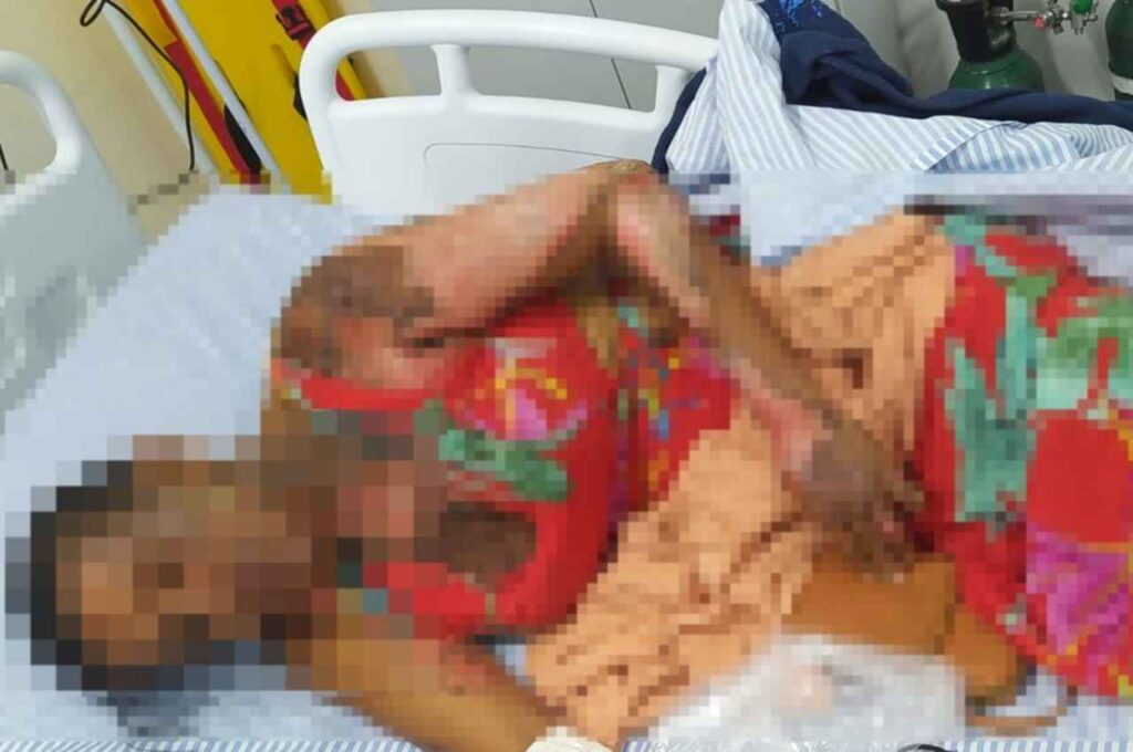 Mulher morre em Maceió após ter 70% do corpo queimado; suspeito está preso