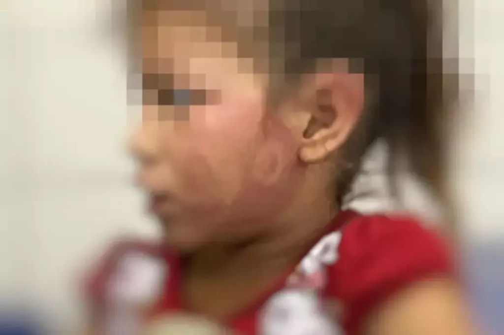 Homem é preso após filha de 6 anos chegar à escola com marca de chinelada no rosto em AL