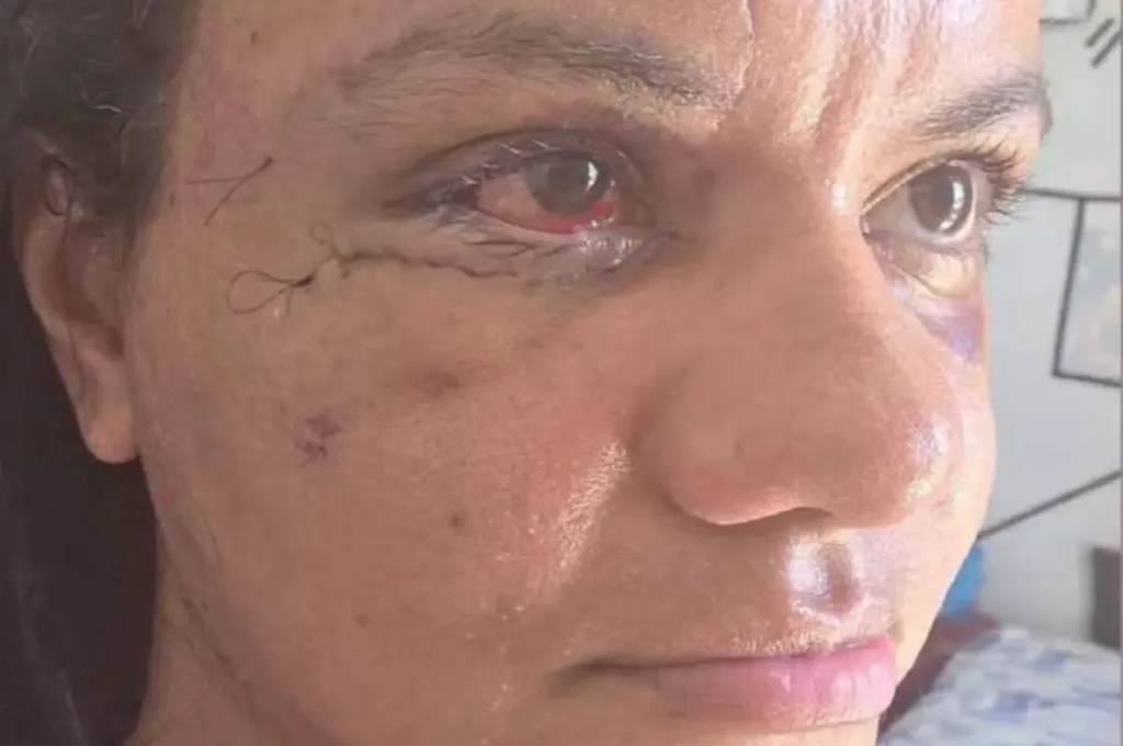 Mulher divulga imagem do rosto reconstruído em cirurgia depois de ser espancada com mais de 60 socos